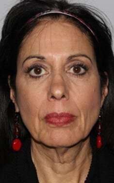 All Me Facelift Before & After Patient #770