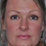 All Me Facelift Before & After Patient #781