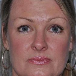 All Me Facelift Before & After Patient #781