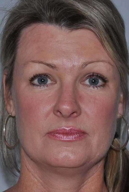 All Me Facelift Before & After Patient #781