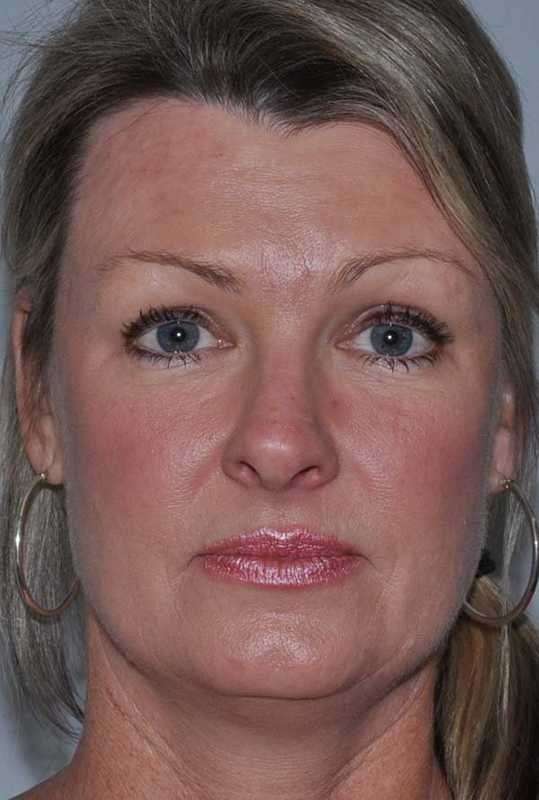 All Me Facelift Before & After Patient #781