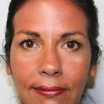 All Me Facelift Before & After Patient #786