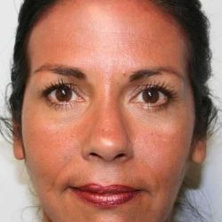 All Me Facelift Before & After Patient #786