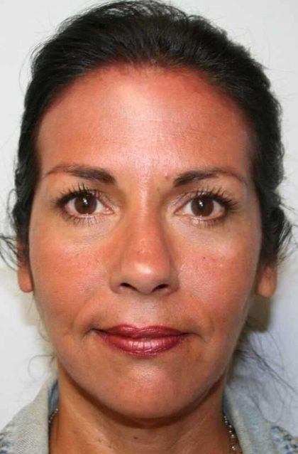 All Me Facelift Before & After Patient #786