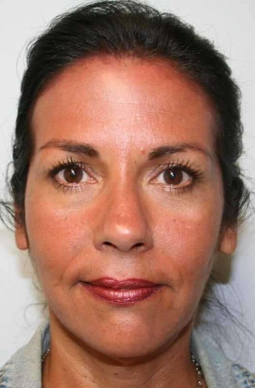 All Me Facelift Before & After Patient #786