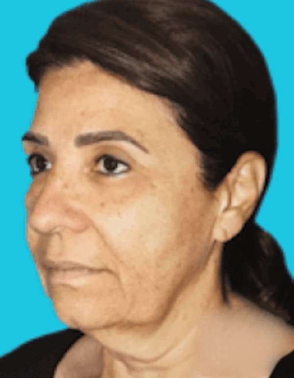 All Me Facelift Before & After Patient #789