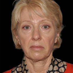 All Me Facelift Before & After Patient #308