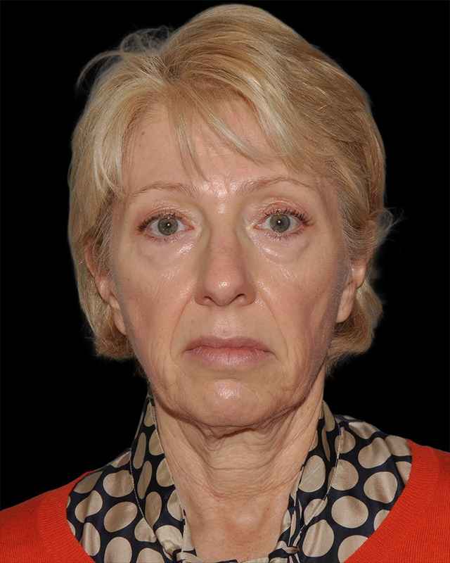 All Me Facelift Before & After Patient #308