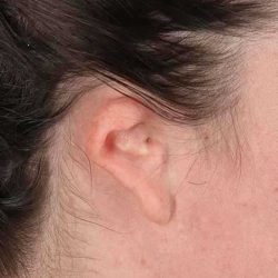 Ear Reconstruction / Microtia Before & After Patient #792