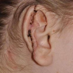Ear Reconstruction / Microtia Before & After Patient #797