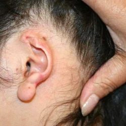 Ear Reconstruction / Microtia Before & After Patient #803