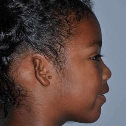 Ear Reconstruction / Microtia Before & After Patient #806