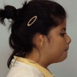 Ear Reconstruction / Microtia Before & After Patient #811
