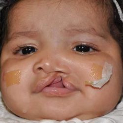 Cleft Lip Palate Before & After Patient #817