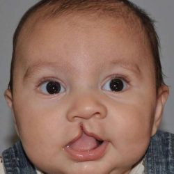 Cleft Lip Palate Before & After Patient #820