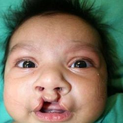 Cleft Lip Palate Before & After Patient #823