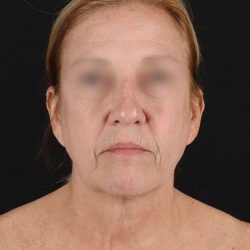 All Me Facelift Before & After Patient #320