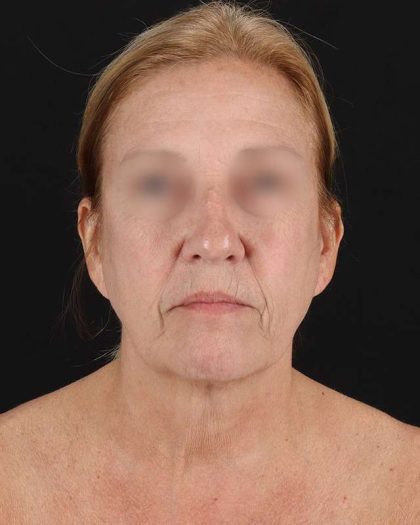 All Me Facelift Before & After Patient #320