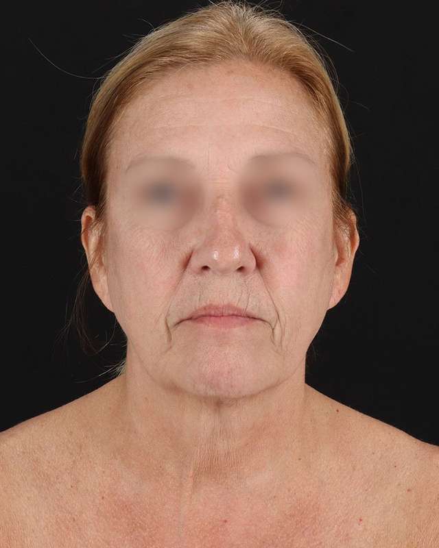 All Me Facelift Before & After Patient #320