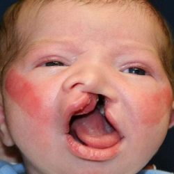 Cleft Lip Palate Before & After Patient #829
