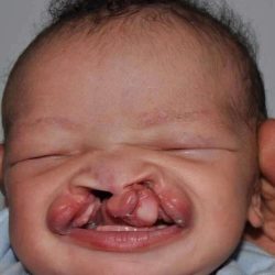 Cleft Lip Palate Before & After Patient #835