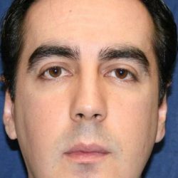 Chin Surgery Before & After Patient #849