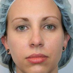Chin Surgery Before & After Patient #854
