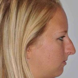 Chin Surgery Before & After Patient #857