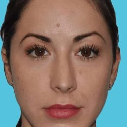 Chin Surgery Before & After Patient #870