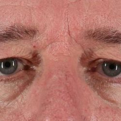 Blepharoplasty (Eyelid Surgery) Before & After Patient #895