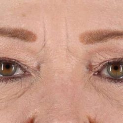 Blepharoplasty (Eyelid Surgery) Before & After Patient #902