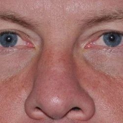 Blepharoplasty (Eyelid Surgery) Before & After Patient #916