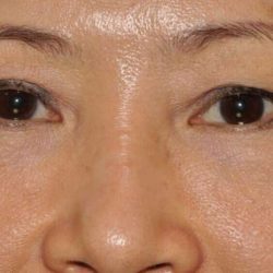 Blepharoplasty (Eyelid Surgery) Before & After Patient #923