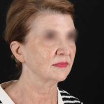 All Me Facelift Before & After Patient #240