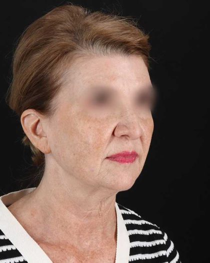 All Me Facelift Before & After Patient #240