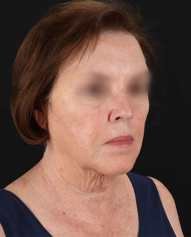 All Me Facelift Before & After Patient #354