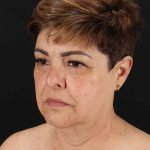All Me Facelift Before & After Patient #373