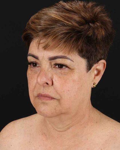 All Me Facelift Before & After Patient #373