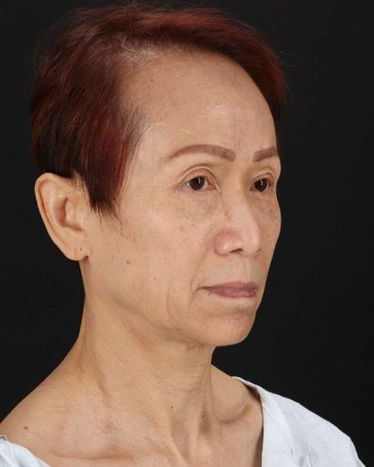 All Me Facelift Before & After Patient #395