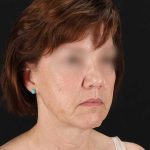 All Me Facelift Before & After Patient #229