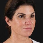 All Me Facelift Before & After Patient #406