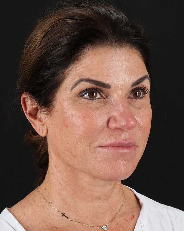 All Me Facelift Before & After Patient #406