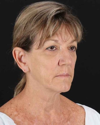 All Me Facelift Before & After Patient #418