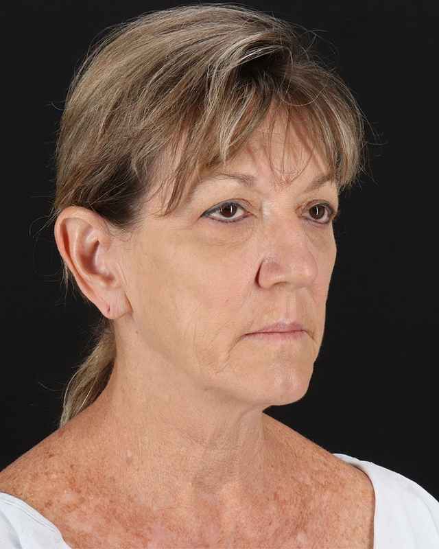 All Me Facelift Before & After Patient #418