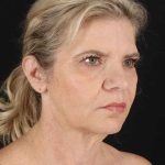 All Me Facelift Before & After Patient #428