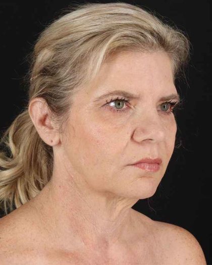 All Me Facelift Before & After Patient #428