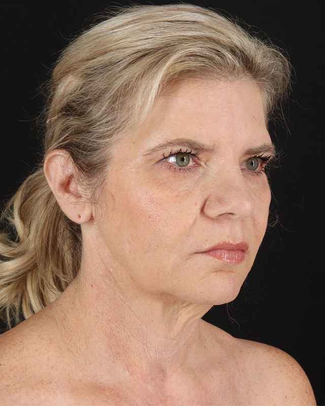 All Me Facelift Before & After Patient #428
