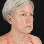 All Me Facelift Before & After Patient #439