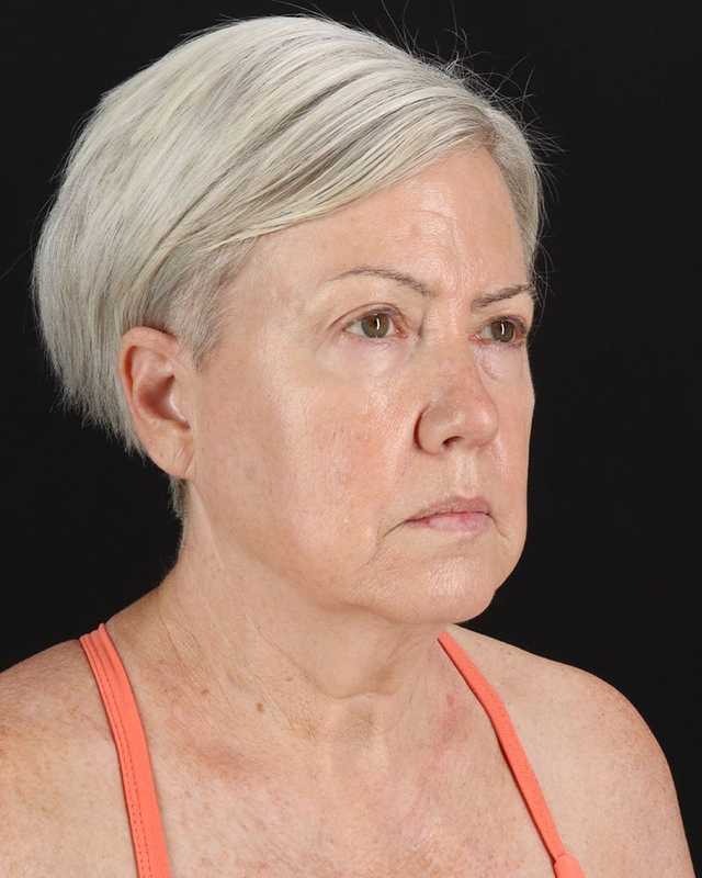 All Me Facelift Before & After Patient #439