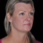 All Me Facelift Before & After Patient #252